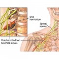 σπονδυλικη στηλη - μυοσκελετικου συστηματος - παθησεις - Αυχενικό σύνδρομο Σπονδυλική Στήλη