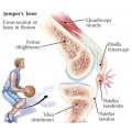 Τενοντοπάθεια επιγονατιδικού τένοντα - Γόνατο αλτών (Jumper's knee)